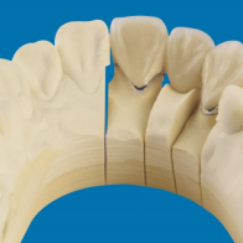 Метал-порцеланови зъби